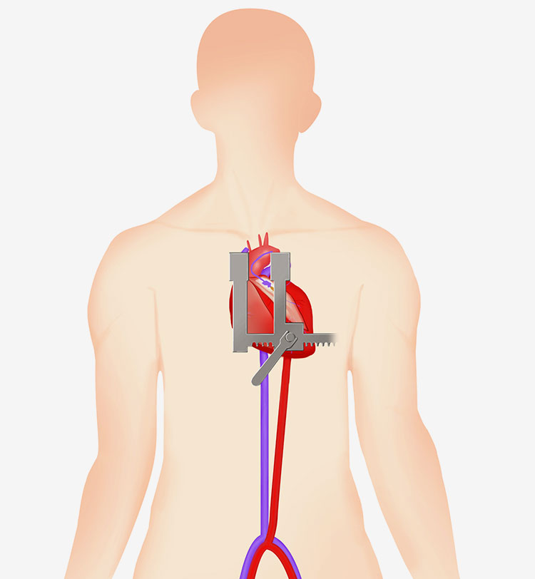 Surgical Aortic Valve Replacement (SAVR)