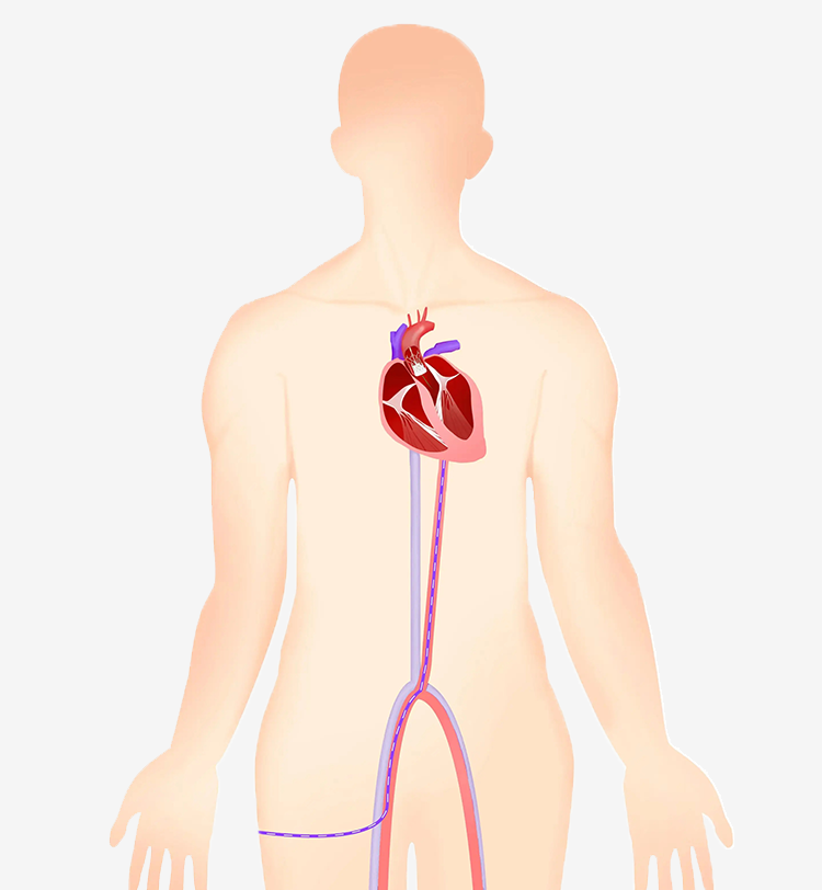 Transcatheter Aortic Valve Implantation (TAVI)