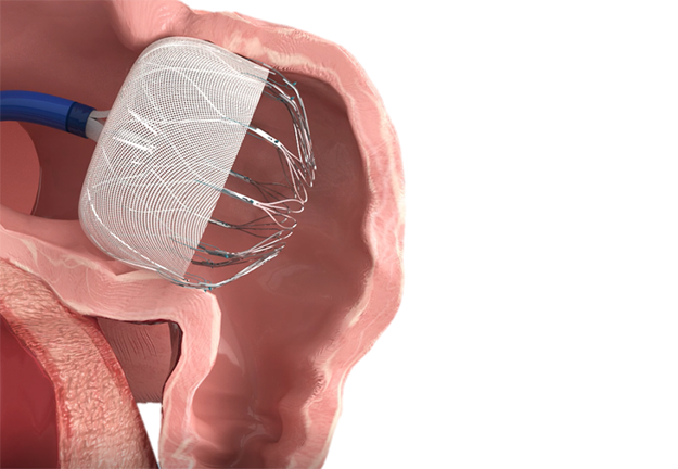 Left Atrial Appendage Closure (LAAC)