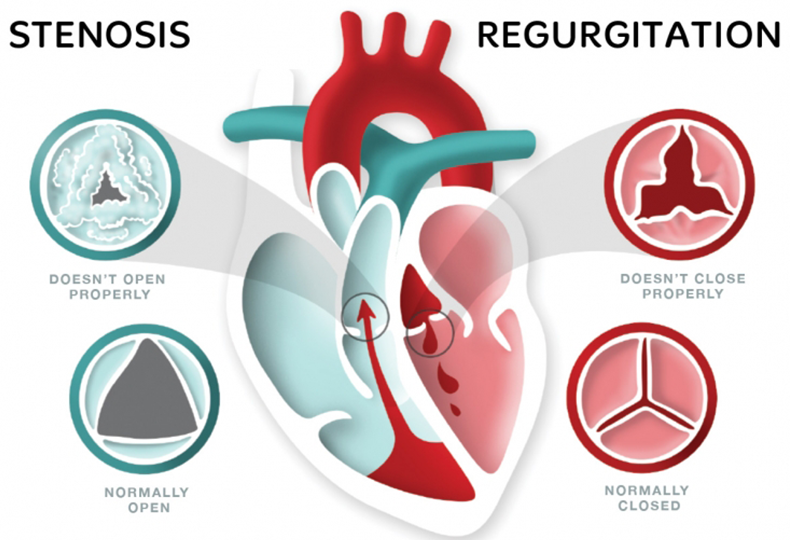 【AS】How to Differentiate Between Aortic Valve Stenosis and Aortic Valve Regurgitation?