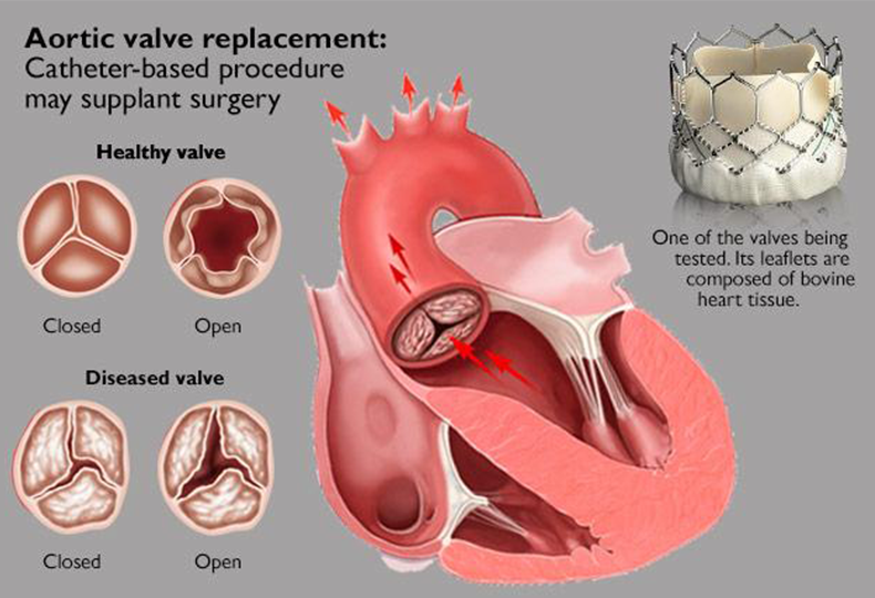 【AS】What Happens After Aortic Valve Replacement Surgery? What Can I Do?