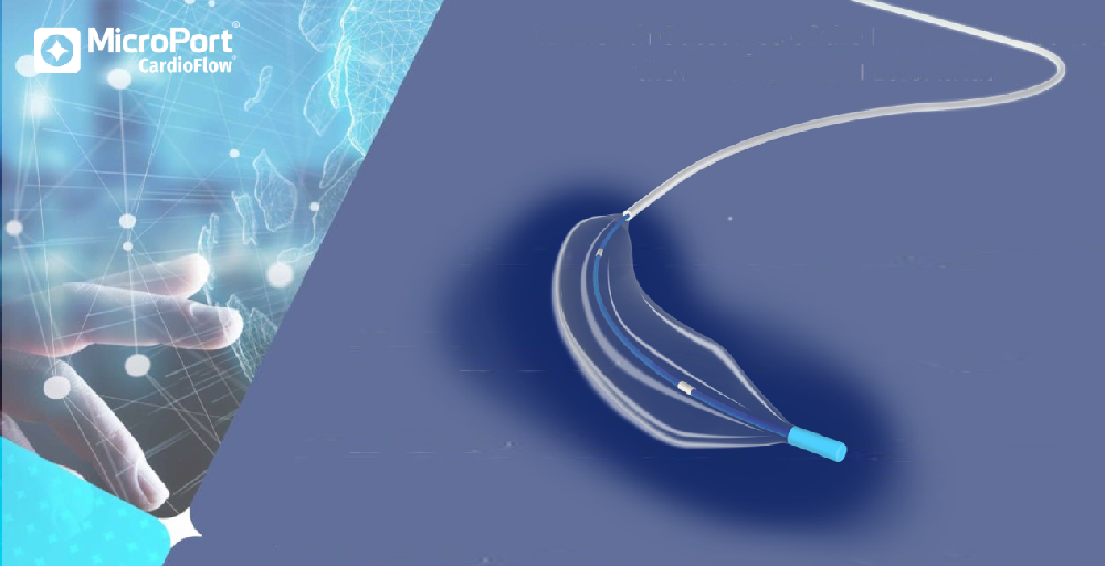 MicroPort CardioFlow's Alwide<sup>®</sup> Plus Obtains EU CE Mark Approval